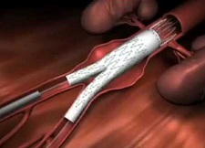 The Zenith Alpha Thoracic Stent Graft from Cook Medical